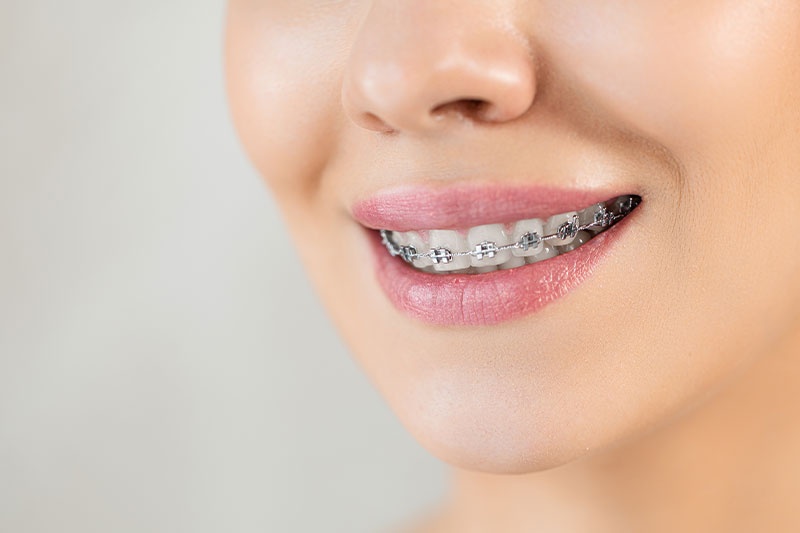 Braces in Hamilton & Stevensville, MT