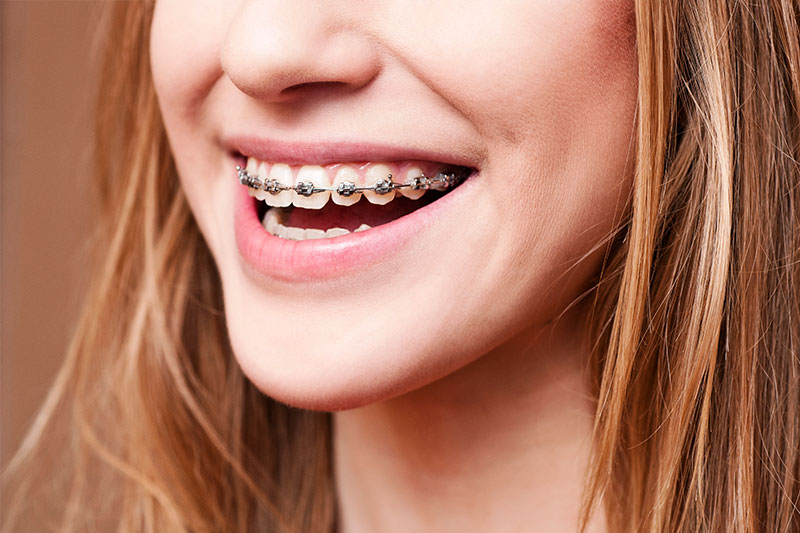 Orthodontics in Hamilton & Stevensville, MT
